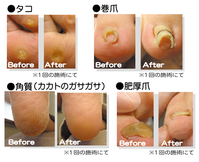 爪のトラブル事例？